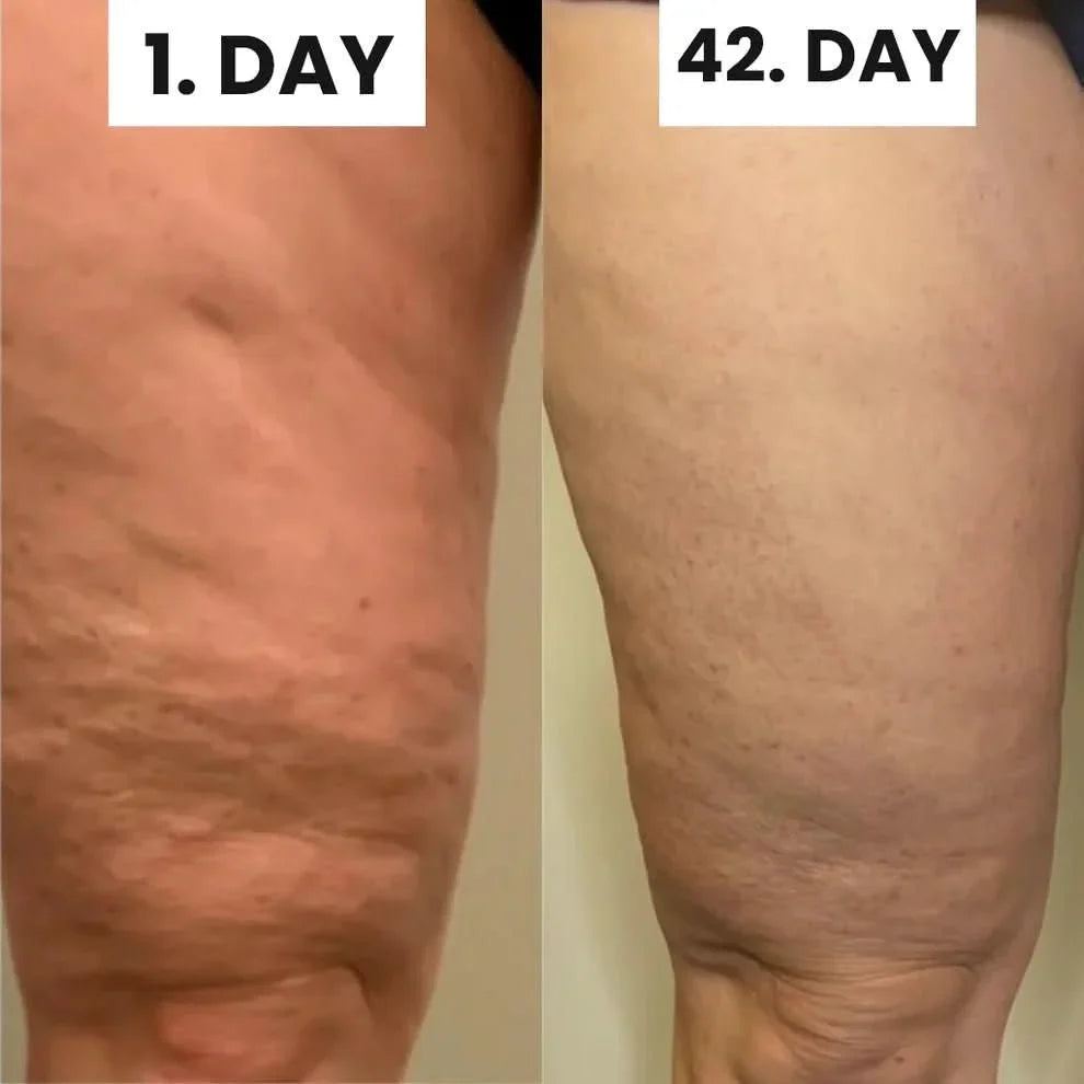 Cellulite Relief Kit